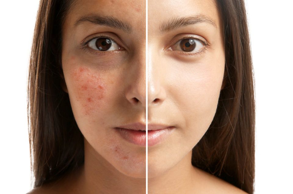 Acne behandeling