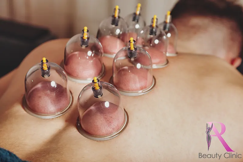 Alles wat je moet weten over cuppingtherapie 1