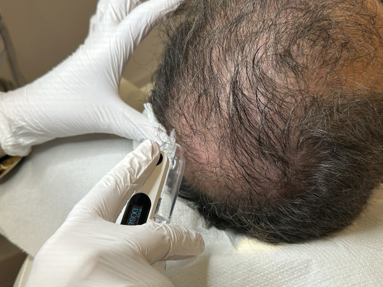 haarfiller behandeling