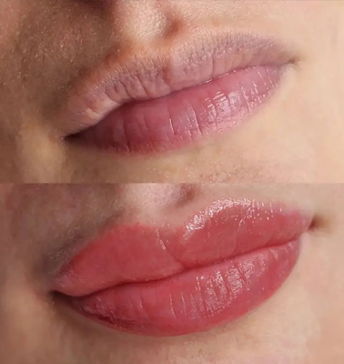 Lip pigmentatie