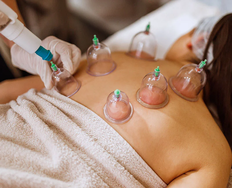 natte cupping