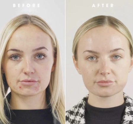 skinbooster