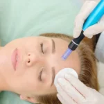 Voordelen van Microneedling