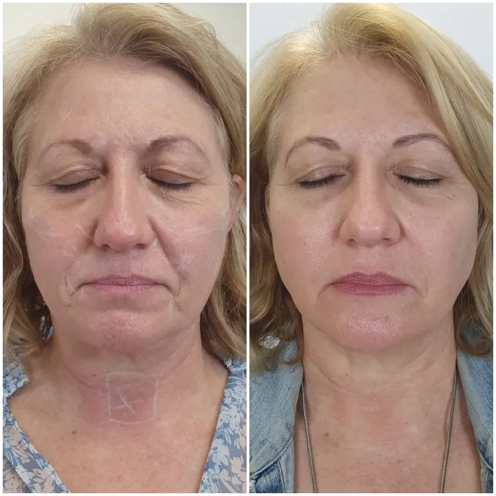 HIFU Full Face Amsterdam