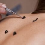 Indicaties voor Bloedzuigertherapie