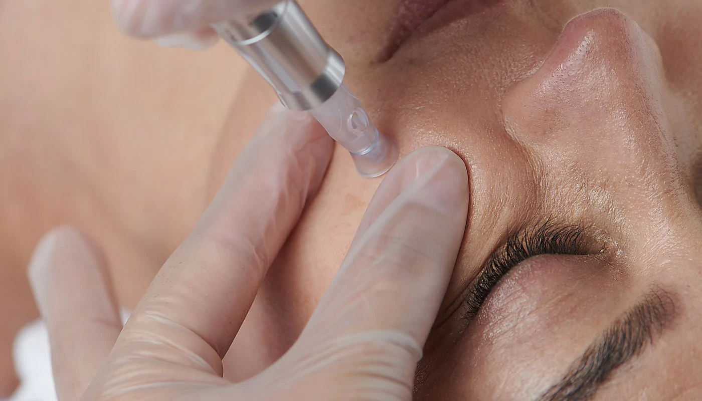 Mesotherapie & Microneedling Amsterdam
