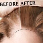 Haar Fillers voor Vrouwen