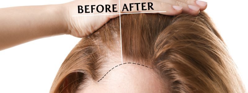 Haar Fillers voor Vrouwen