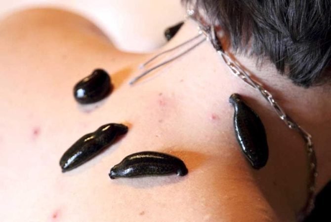 Voordelen van Bloedzuigertherapie