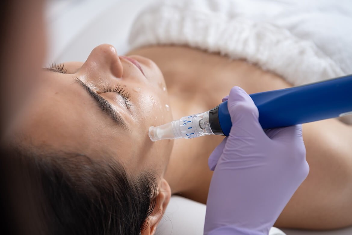 Microneedling Treatment