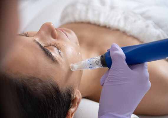 Microneedling