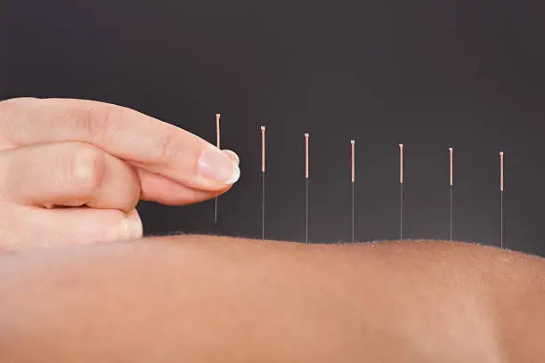 Acupunctuur