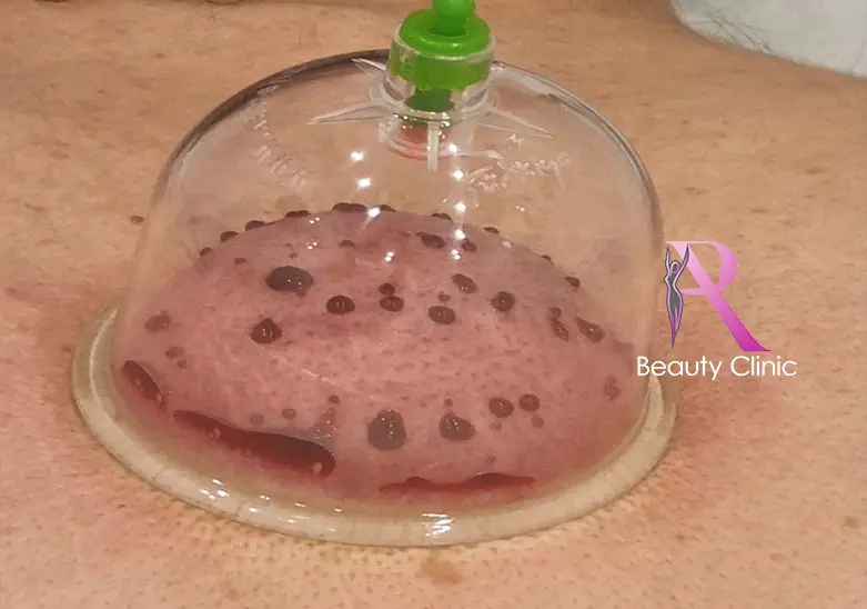 Natte Cupping