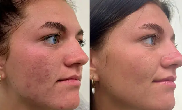 microneedling before after