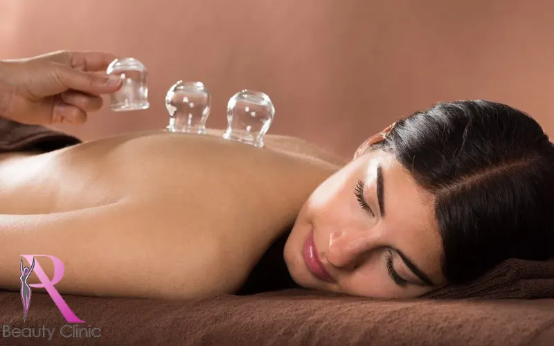 Alles wat je moet weten over cuppingtherapie