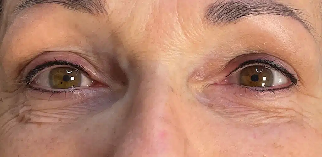 Permanent Make-up Verwijderen
