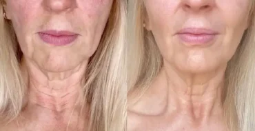 microneedling before after