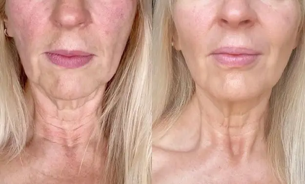 microneedling before after
