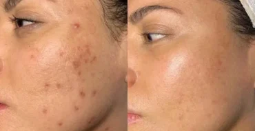microneedling before after