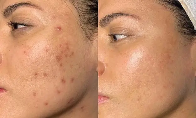 microneedling before after