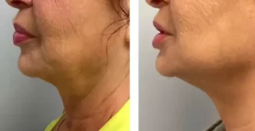 HIFO & microneedling before after