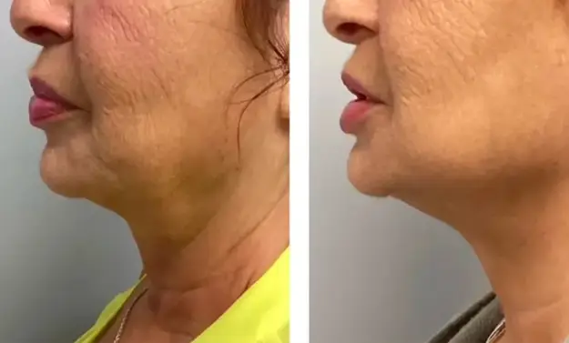 HIFO & microneedling before after