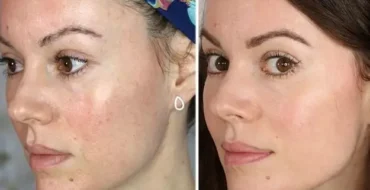 HIFO & microneedling before after