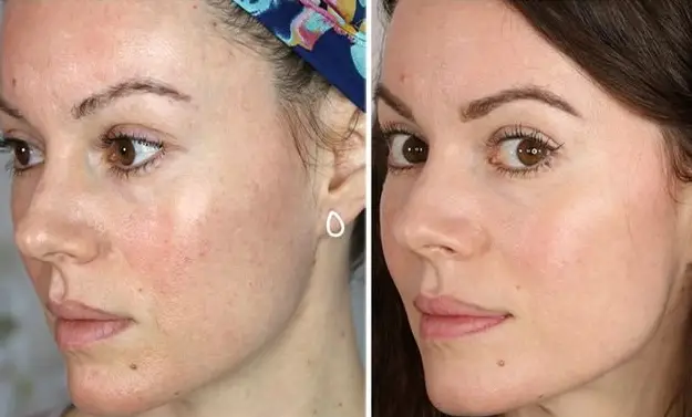 HIFO & microneedling before after