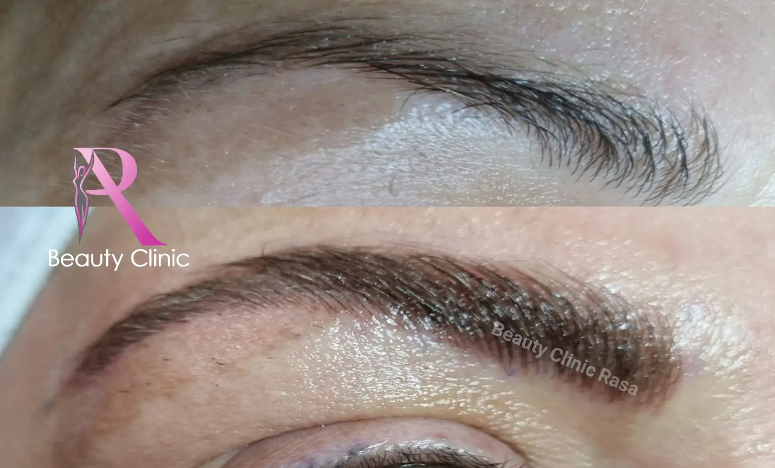 HIFO & microneedling before after