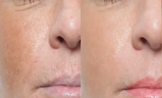 HIFO & microneedling before after