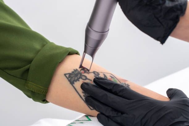 Laser Tatoeage Verwijderen bij Beauty Clinic Rasa