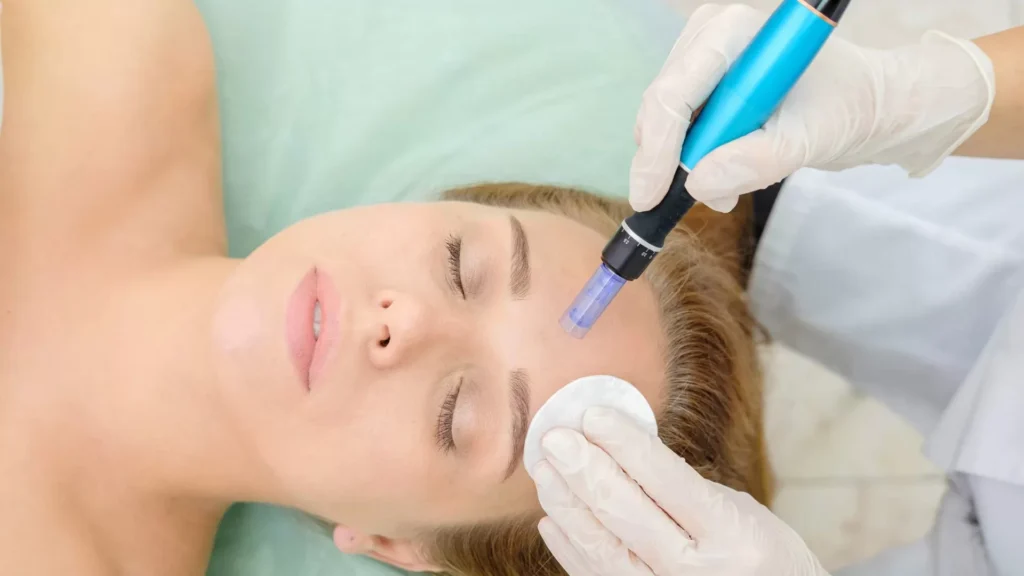 Microneedling Treatment