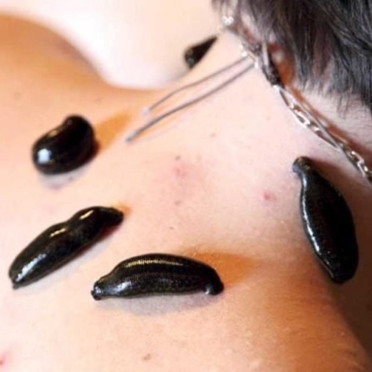 Voordelen van Bloedzuigertherapie