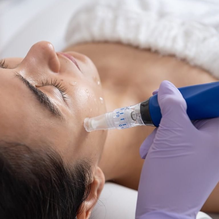 Microneedling Treatment