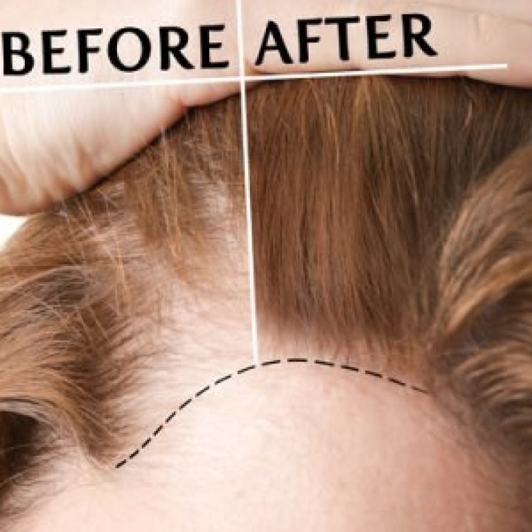 Haar Fillers voor Vrouwen